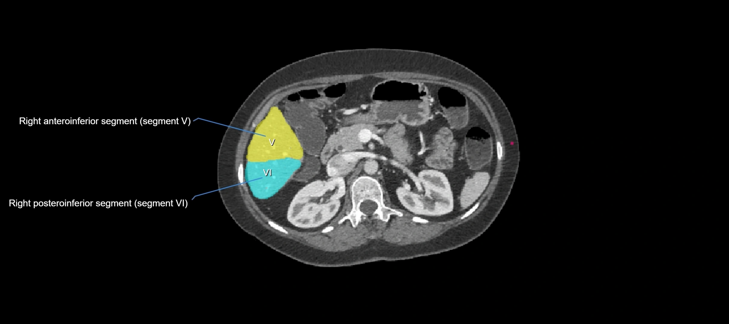 CT liver segments axial cross sectional anatomy labelled image-00029.webp